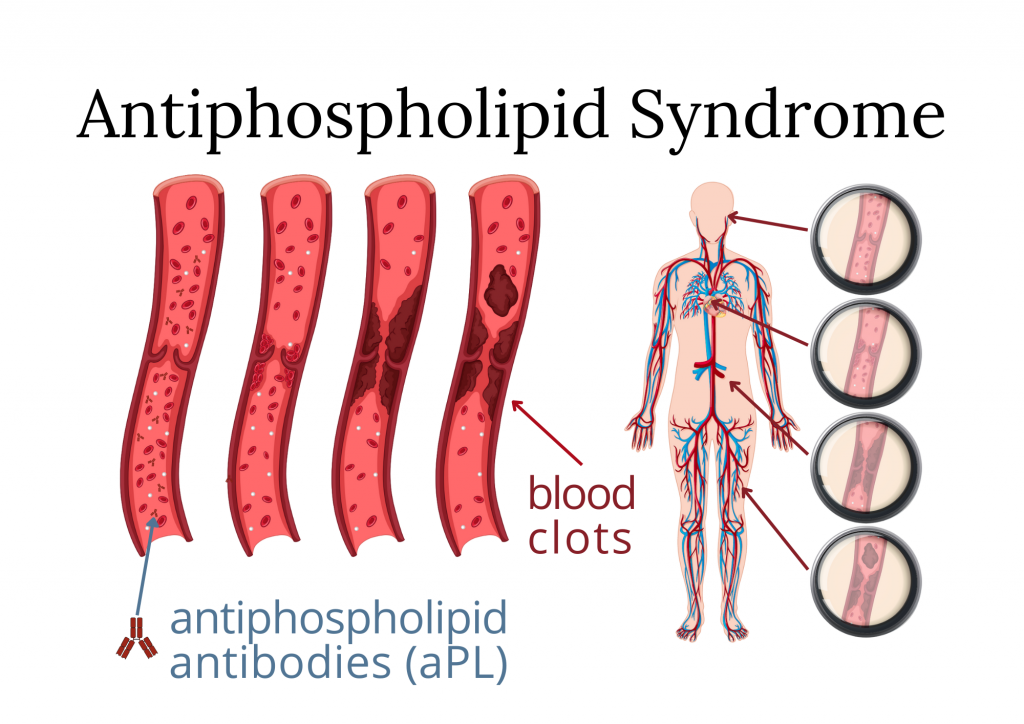 Antiphospholipid Syndrome - ERN ReCONNET | European Reference Network ...